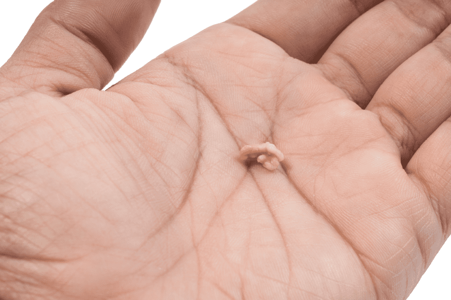 How to get rid of tonsil stones