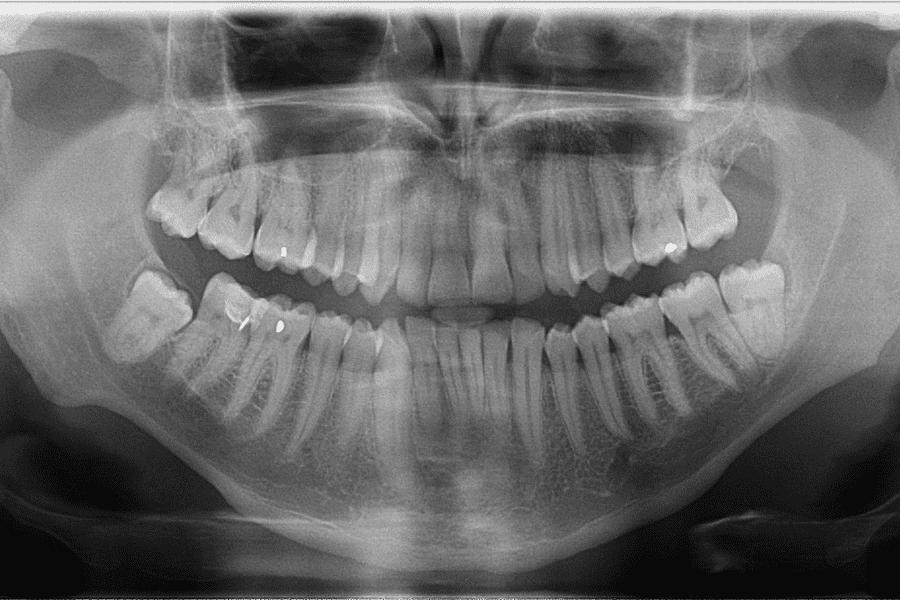 X-ray of a persons mouth.